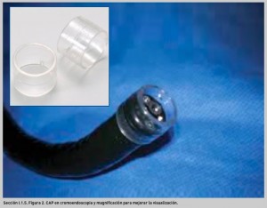 FIGURA 2. CAP en cromoendoscopia y magnificación para mejorar la visualización.