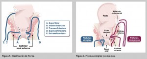 FIGURA 3. Algoritmo de tratamiento en enfermedad fistulosa perianal.