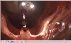 FIGURA 5. Polipectomía con pinza c