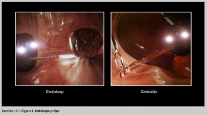FIGURA 8. Endoloops y clips.