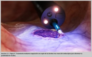 FIGURA 9. Tratamiento mediante coagulación con argón de los bordes tras resección endoscópica para disminuir la posibilidad de recidiva.