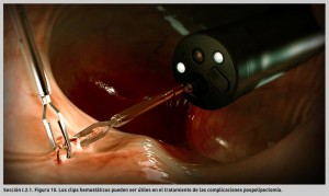 FIGURA 10. Resección mucosa utilizando un colonoscopio de doble canal (pinzas y asa de diatermia).