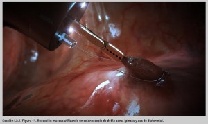FIGURA 11. Resección mucosa utilizando un colonoscopio de doble canal (pinzas y asa de diatermia).