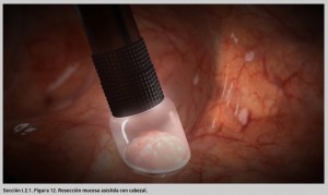 FIGURA 12. Resección mucosa asistida con cabezal.