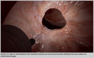 FIGURA 4. Enfermedad de Crohn. Estenosis refractaria con recurrencias frecuentes. Realización de cortes radiales con esfinterotoma de aguja.