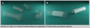 FIGURA 2. A. Prótesis de distintos diámetros y longuitudes. B. Prótesis total y parcialmente cubiertas.