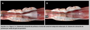 FIGURA 3. A. Sistema de colocación de prótesis a través del canal de trabajo del endoscopio. B. Sistema de colocación de prótesis por medio de guía (en paralelo).