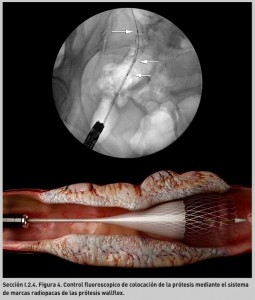 FIGURA 4. Control fluoroscopico de colocación de la prótesis mediante el sistema de marcas radiopacas de las prótesis wallflex.
