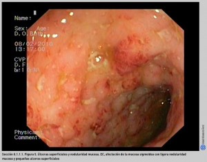 FIGURA 5. Úlceras superficiales y nodularidad mucosa.