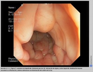 FIGURA 7. Lesiones en empedrado. Estenosis parcial.