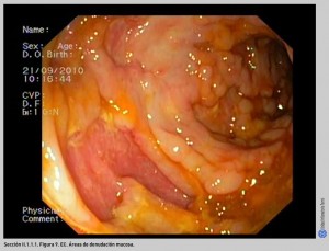 FIGURA 9. EC. Áreas de denudación mucosa.