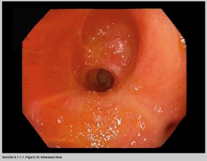 FIGURA 10. Estenosis ileal.