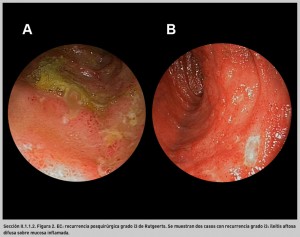 FIGURA 2. EC: recurrencia posquirúrgica grado i3 de Rutgeerts.