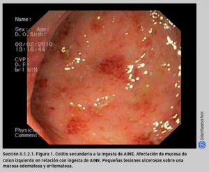 FIGURA 1. Colitis secundaria a la ingestade AINE.