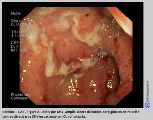 FIGURA 2. Colitis por CMV.
