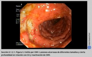FIGURA 3. Colitis por CMV.