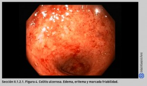 FIGURA 4. Colitis ulcerosa.