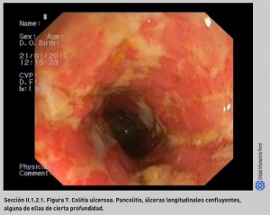 FIGURA 7. Colitis ulcerosa.