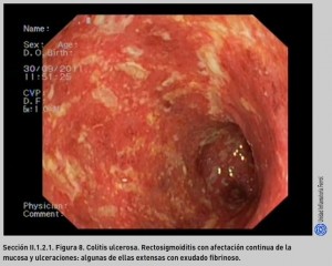 FIGURA 8. CU. Úlceras confluyentes.