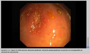 FIGURA 10. Colitis ulcerosa. Afectación apendicular