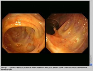 FIGURA 3. Pancolitis ulcerosa de 15 años de evolución.