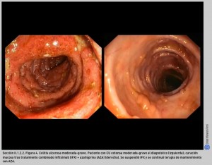 FIGURA 4. Colitis ulcerosa moderada-grave.