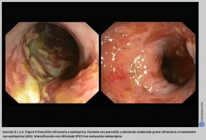 FIGURA 5. Pancolitis refractaria a azatioprina.