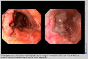 FIGURA 6. CU extensa refractaria.