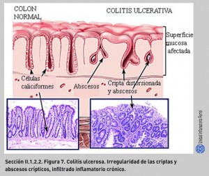 FIGURA 7. Colitis ulcerosa.