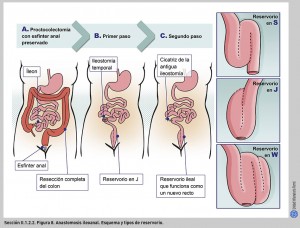 FIGURA 8. Anastomosis ileoanal. Esquema y tipos de reservorio.