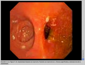 FIGURA 9. CU. Anastomosis ileoanal con reservorio.