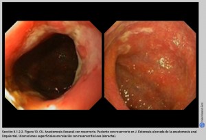 FIGURA 10. CU. Anastomosis ileoanal con reservorio.