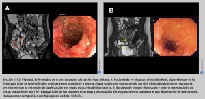FIGURA 2. Enfermedad de Crohn de debut. Afectación ileal aislada.