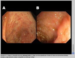 FIGURA 3. Pancolitis ulcerosa. Backwash ileítis.