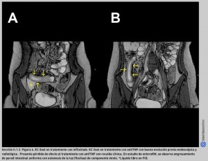 FIGURA 6. EC ileal en tratamiento con infliximab.