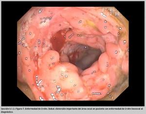 FIGURA 7. Enfermedad de Crohn. Debut.