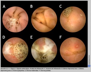 FIGURA 4. Cápsula endoscópica. Grados de inflamación