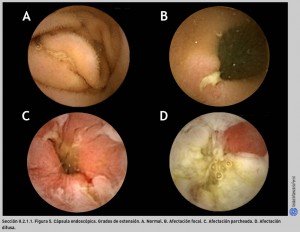 FIGURA 5. Cápsula endoscópica. Grados de extensión N IV