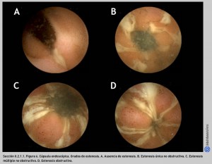 FIGURA 6. Cápsula endoscópica. Grados de estenosis