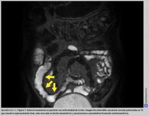 FIGURA 7. Enterorresonancia en paciente con enfermedad de Crohn.