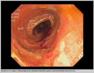 FIGURA 2. Enteroscopia en EC.