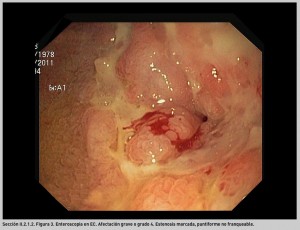 FIGURA 3. Enteroscopia en EC.