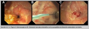 FIGURA 5. Enteroscopia en EC.