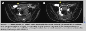 FIGURA 6. EnteroRM para completar estudio de estenosis de íleon terminal.