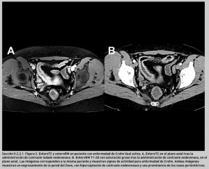 FIGURA 2. EnteroTC y enteroRM en paciente con enfermedad de Crohn ileal activa.
