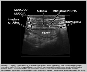 FIGURA 1. Corte trasversal de un asa intestinal en ecografía modo B en un paciente con EC.