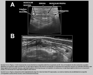FIGURA 1. Corte trasversal de un asa intestinal en ecografía modo B en un paciente con EC.