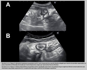 FIGURA 5. Afectación transmural en paciente con EC.