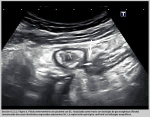 FIGURA 6. Fístula enteroentérica en paciente con EC.