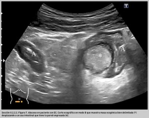 FIGURA 7. Absceso en paciente con EC.